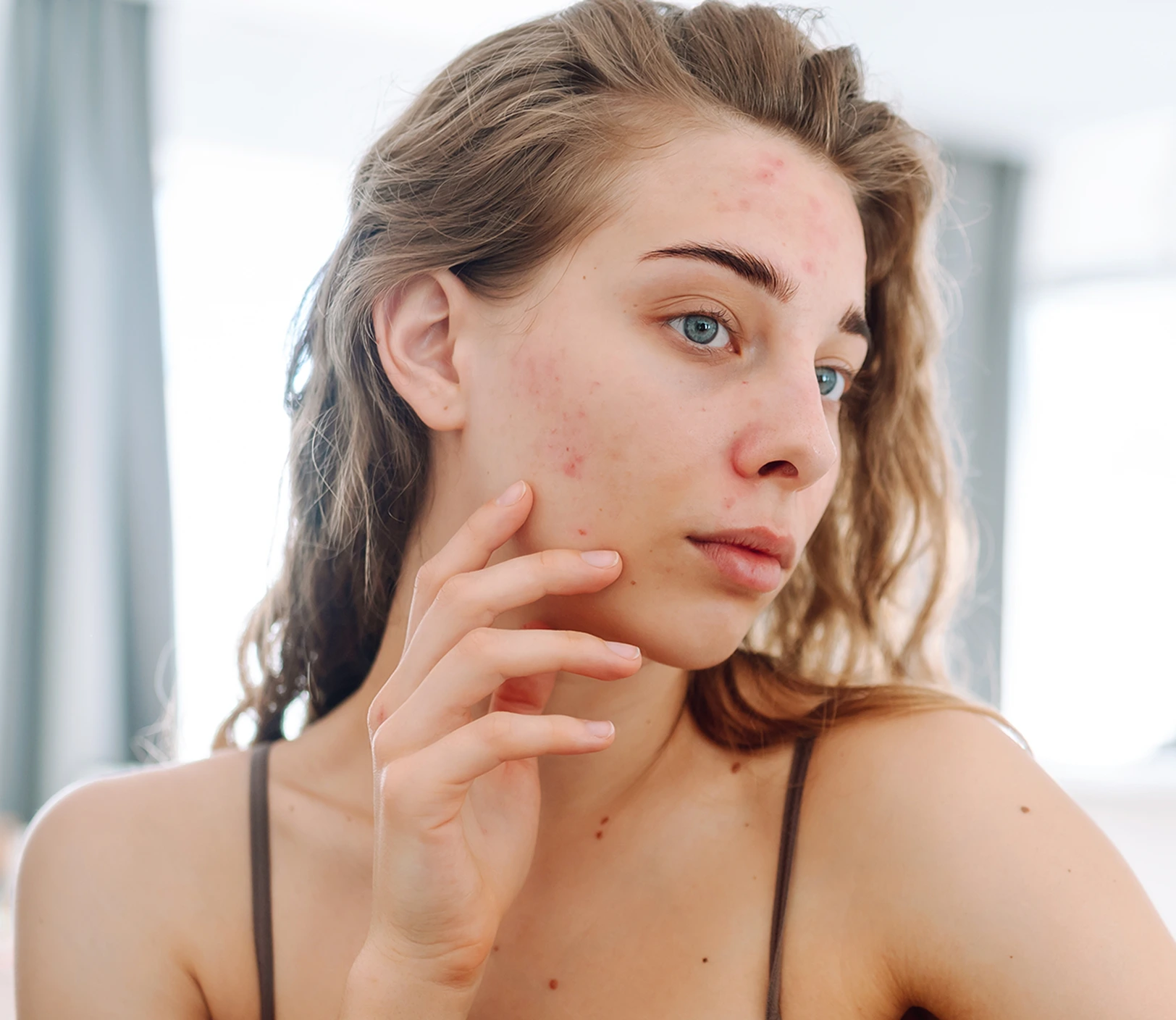 Top Facial Peels in Las Vegas, NV: Who Is a Good Candidate for Facial Peels? Banner